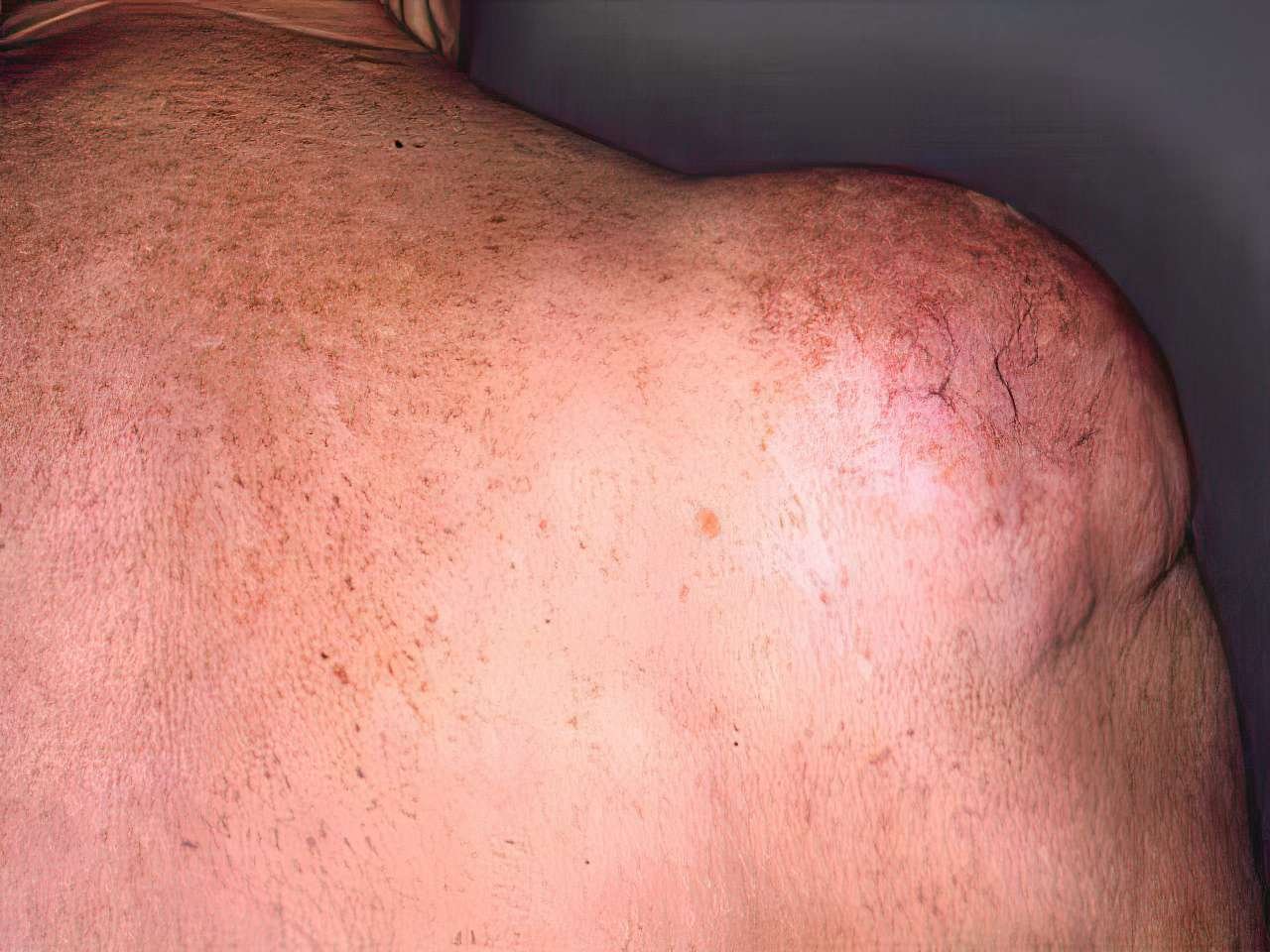 Understanding Lipoma: A Comprehensive Guide by Dr. Imtiaz Hussain