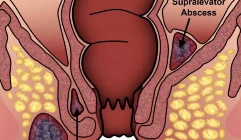  Recurrent Complex Fistula: A Challenging Medical Condition