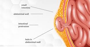 Hernia: A Complete Guide to Understanding, Diagnosing, and Treating the Condition