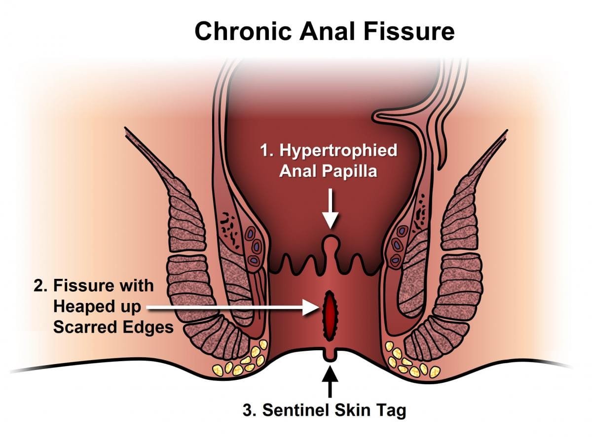 All You Need to Know About Anal Fissures: Causes, Symptoms, and Treatment 